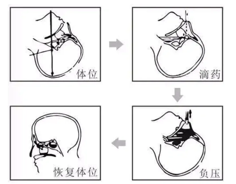 负压洗鼻.png